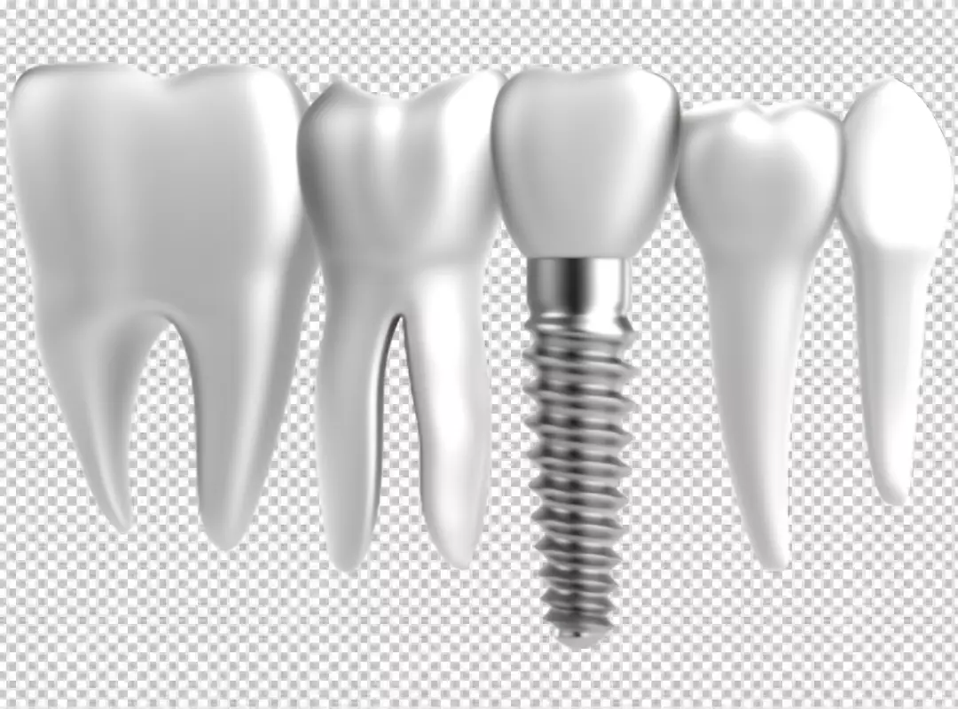 Free Premium PNG a dental implant screw-shaped device that is surgically implanted into the jawbone to replace a missing tooth