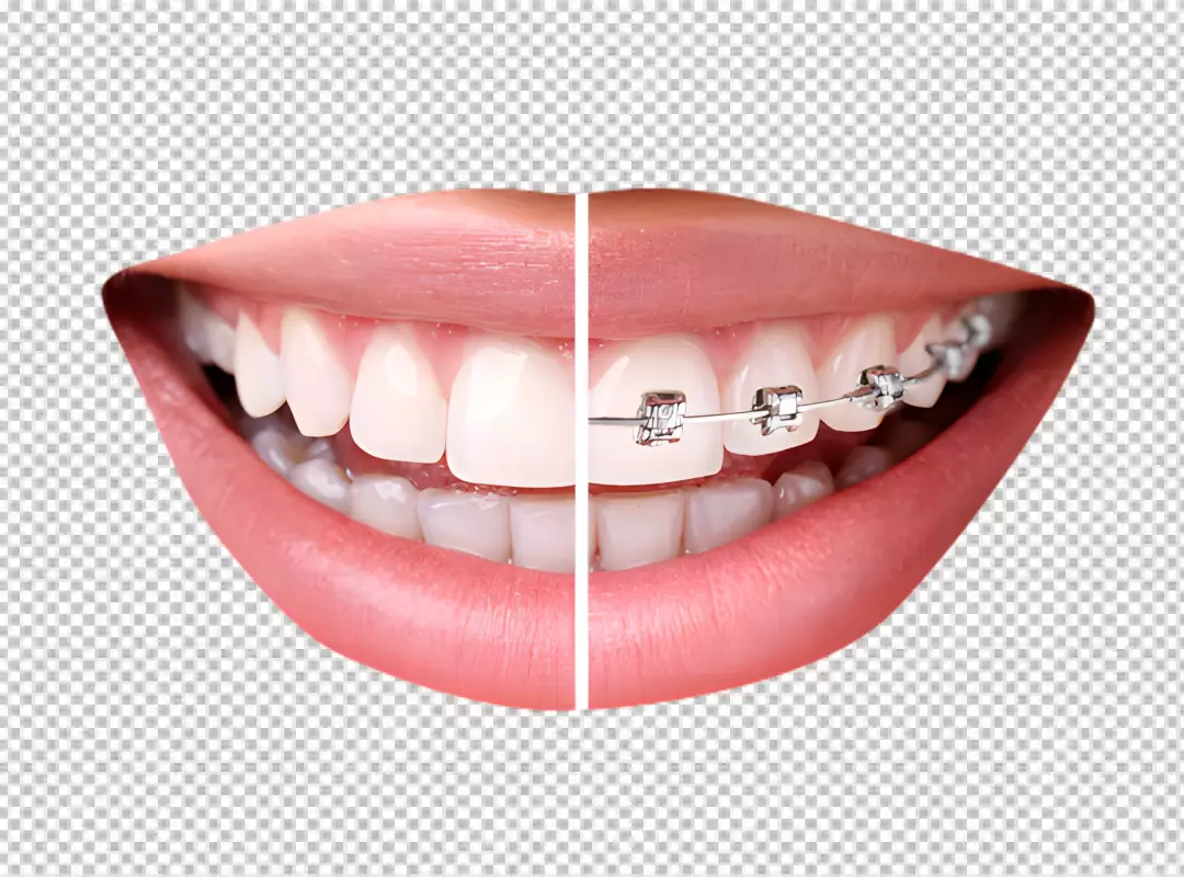 Free Premium PNG a woman's teeth before and after braces