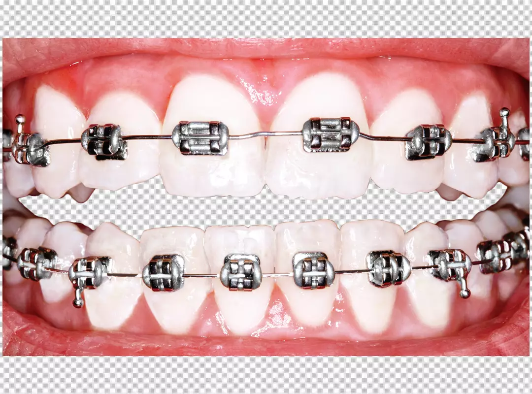 Free Premium PNG a person's teeth with metal braces